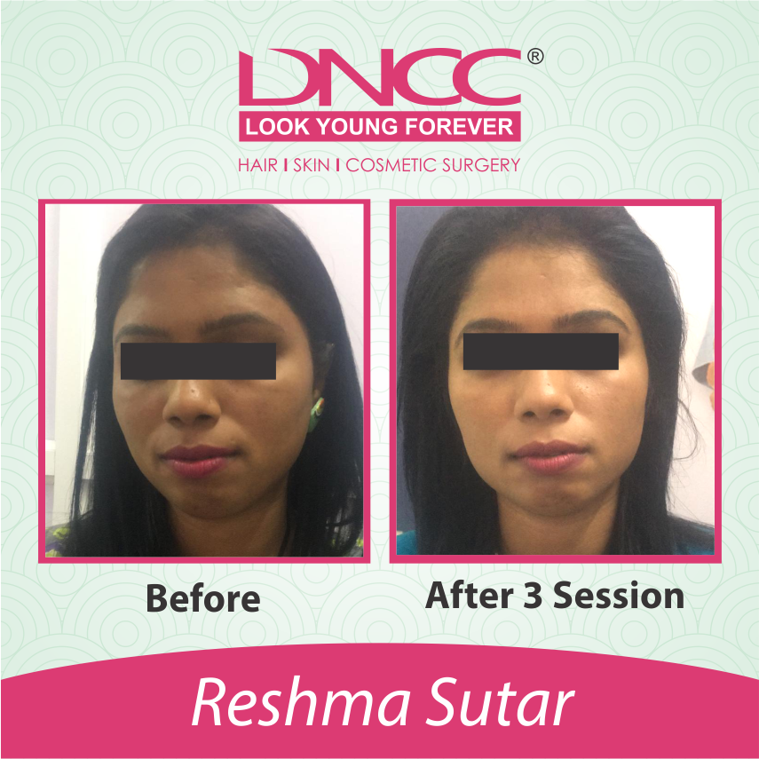 Hair Transplant Transformation 1